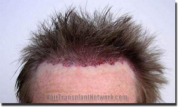 Hair restoration procedure results