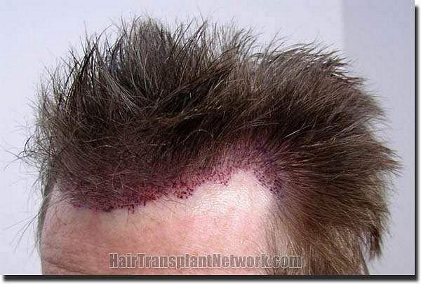 Hair restoration procedure results