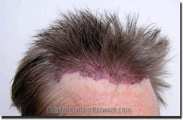 Hair restoration procedure results