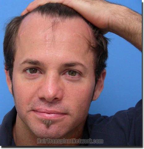 Hair restoration procedure results