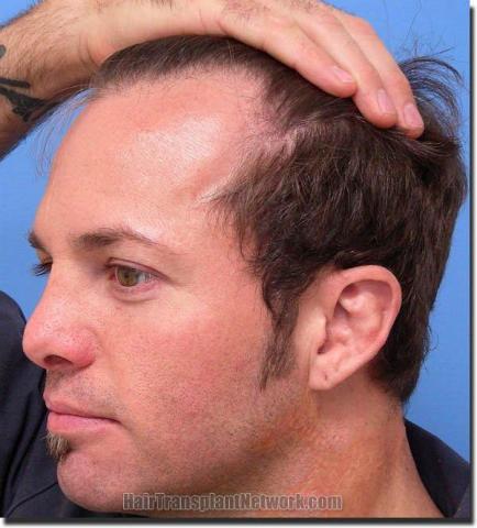 Hair restoration procedure results