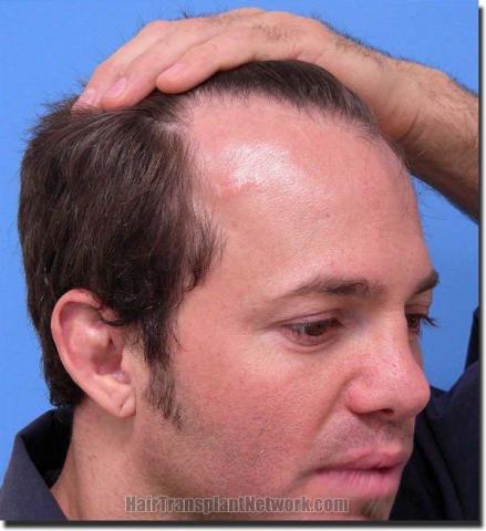 Hair restoration procedure results