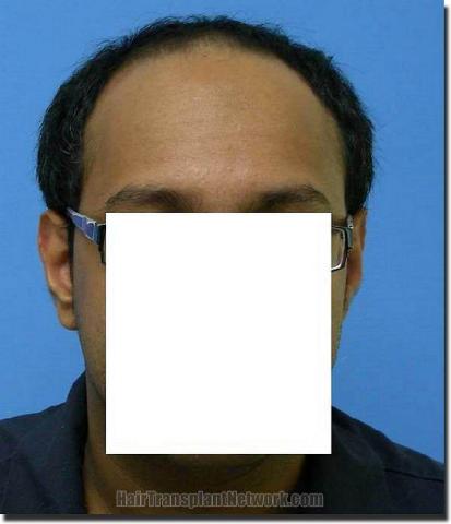 Hair restoration procedure results