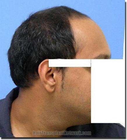 Hair restoration procedure results