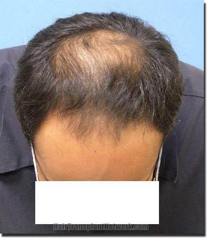 Hair restoration procedure results