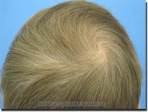 Hair restoration procedure results