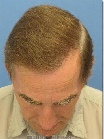 Hair restoration procedure results