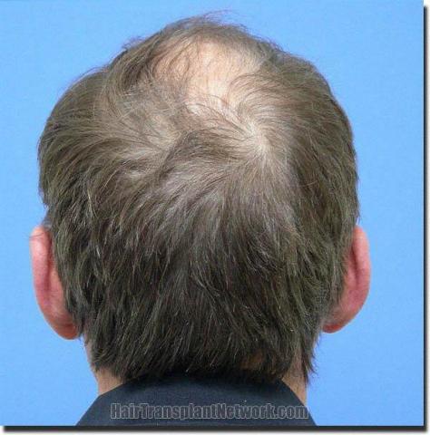 Hair restoration procedure results