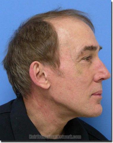 Hair restoration procedure results