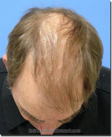 Hair restoration procedure results