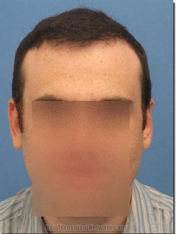 Hair restoration procedure results