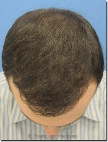 Hair restoration procedure results