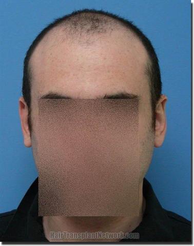 Hair restoration procedure results