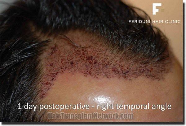 Hair restoration procedure results