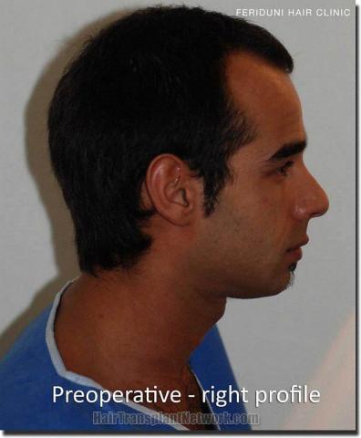 Hair restoration procedure results