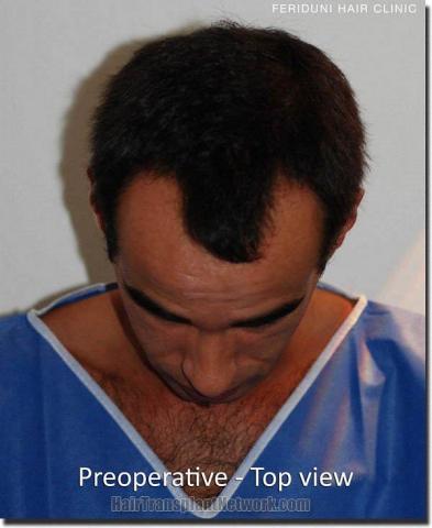 Hair restoration procedure results