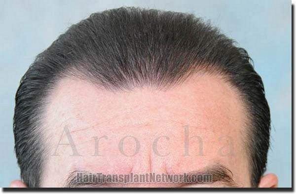 Hair restoration procedure results