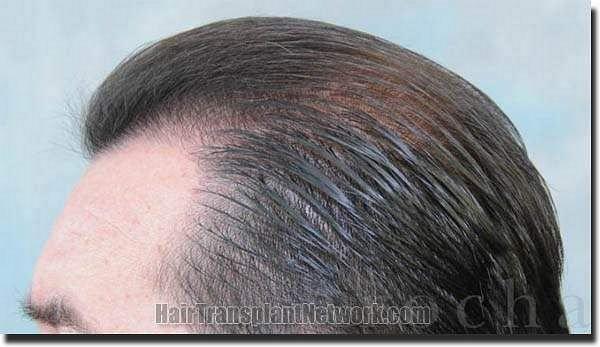 Hair restoration procedure results