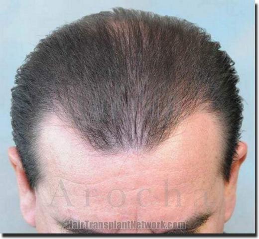 Hair restoration procedure results