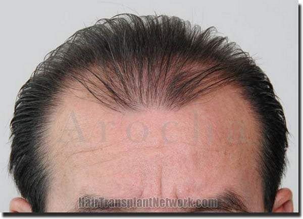 Hair restoration procedure results