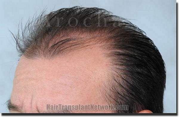 Hair restoration procedure results