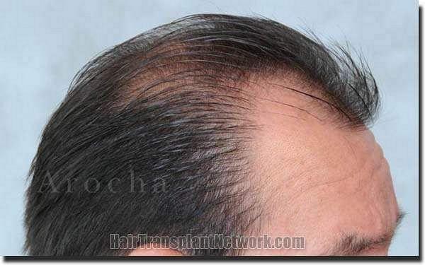 Hair restoration procedure results