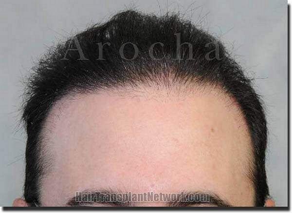 Hair restoration procedure results