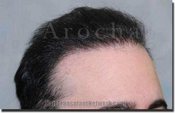 Hair restoration procedure results