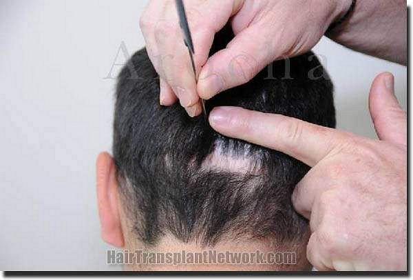 Hair restoration procedure results