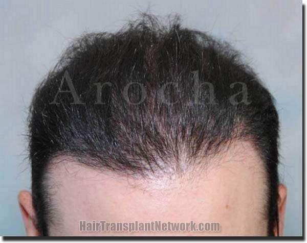 Hair restoration procedure results