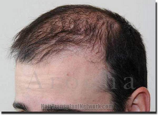 Hair restoration procedure results