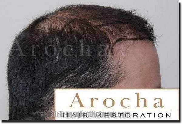 Hair restoration procedure results