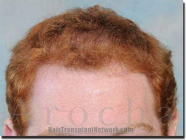 Hair restoration procedure results