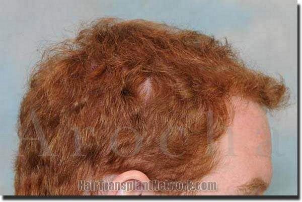 Hair restoration procedure results