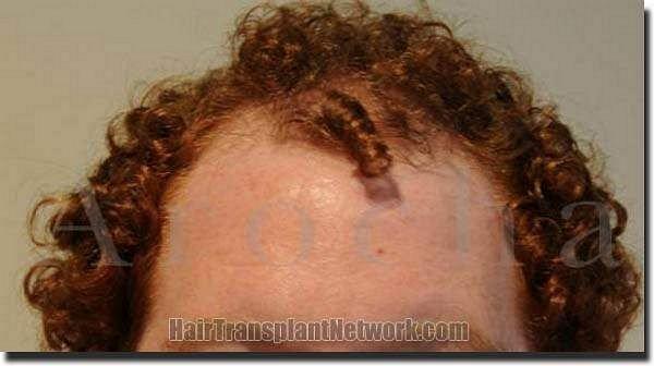 Hair restoration procedure results