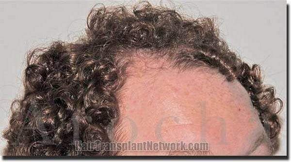 Hair restoration procedure results