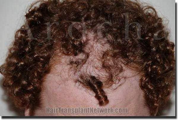 Hair restoration procedure results