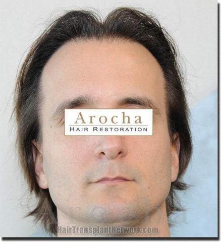 Hair restoration procedure results