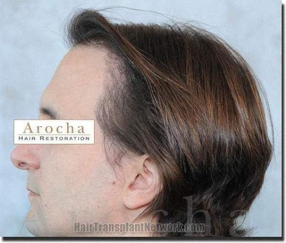 Hair restoration procedure results