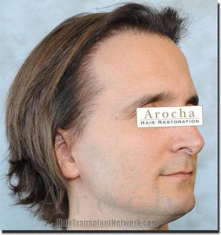 Hair restoration procedure results