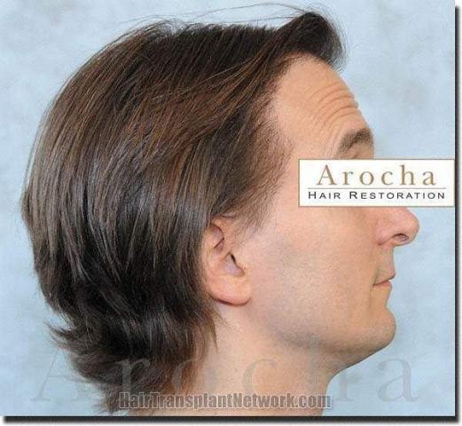 Hair restoration procedure results