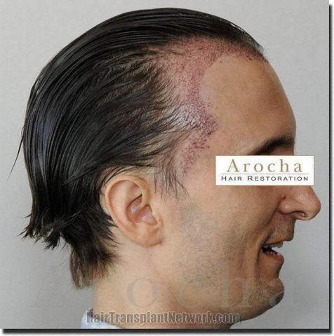 Hair restoration procedure results