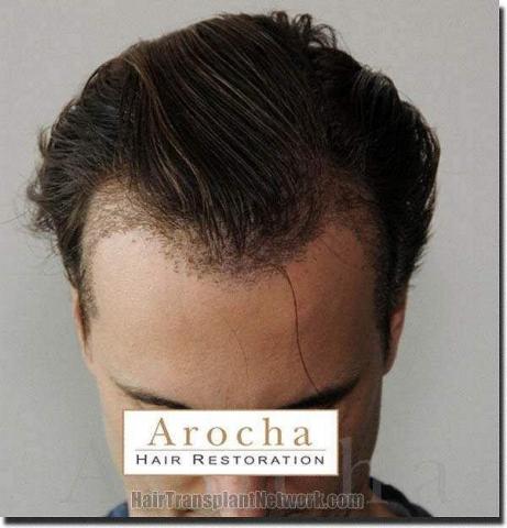 Hair restoration procedure results