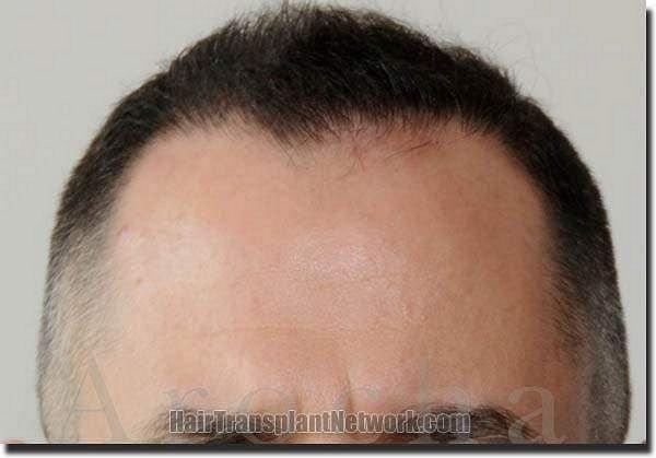 Hair restoration procedure results