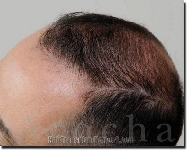 Hair restoration procedure results