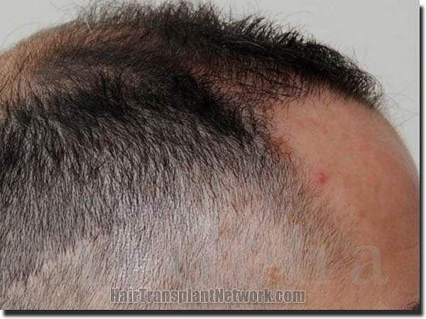 Hair restoration procedure results