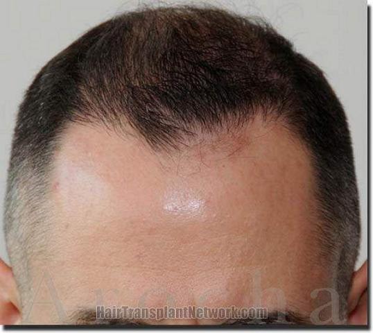 Hair restoration procedure results