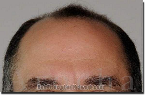 Hair restoration procedure results