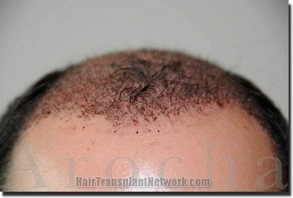 Hair restoration procedure results