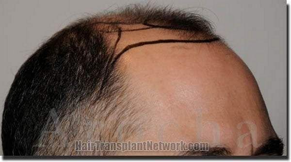 Hair restoration procedure results